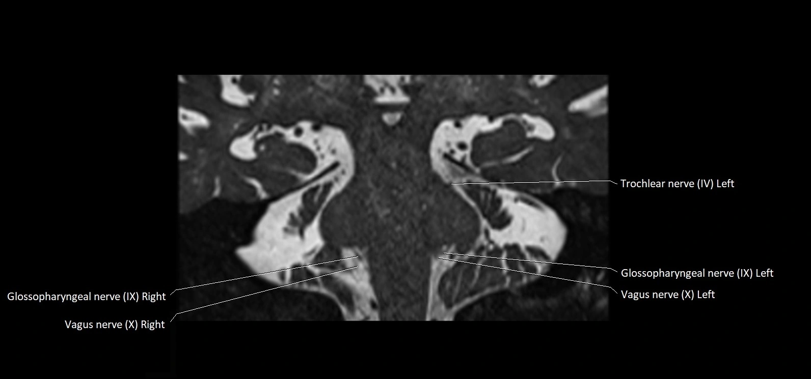 Cranial nerve cross sectional anatomy coronal 3T MRI image 48.webp